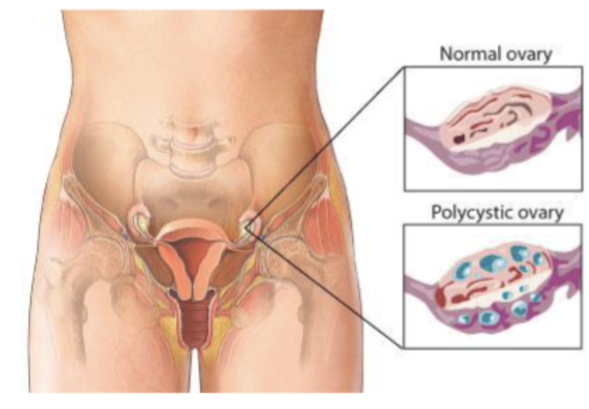 PCOS